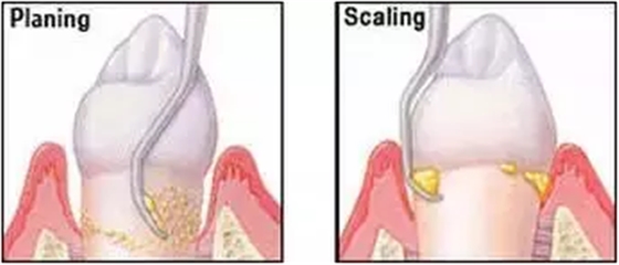為什么洗牙后還要做牙周刮治？