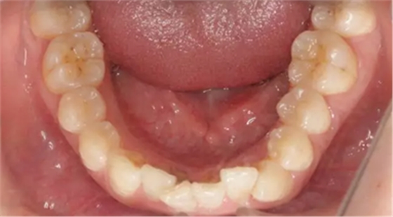 鄰面去釉技術(shù)詳解 鄰面去釉技術(shù)詳解