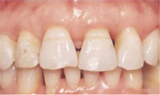 鄰面去釉技術(shù)詳解 鄰面去釉技術(shù)詳解