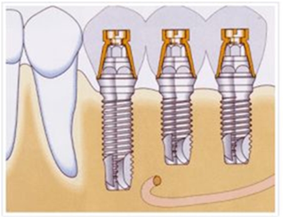 戰(zhàn)&ldquo;疫&rdquo;護(hù)牙方法：&ldquo;坐困家中&rdquo;，誰來救救我的種植牙？