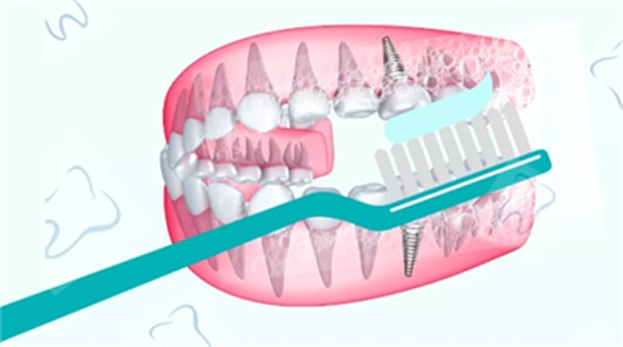 戰(zhàn)&ldquo;疫&rdquo;護(hù)牙方法：&ldquo;坐困家中&rdquo;，誰來救救我的種植牙？