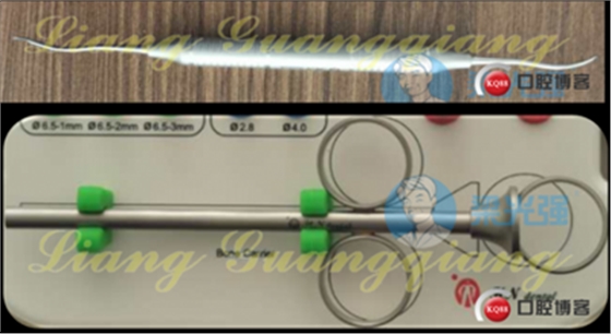 上頜竇外提升術(shù)中對大囊腫的處理 上頜竇外提升術(shù)中對大囊腫的處理