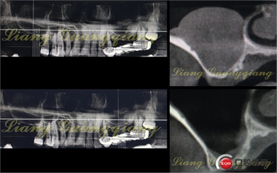 上頜竇外提升術(shù)中對大囊腫的處理 上頜竇外提升術(shù)中對大囊腫的處理
