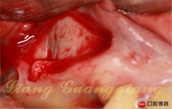 上頜竇外提升術(shù)中對大囊腫的處理 上頜竇外提升術(shù)中對大囊腫的處理