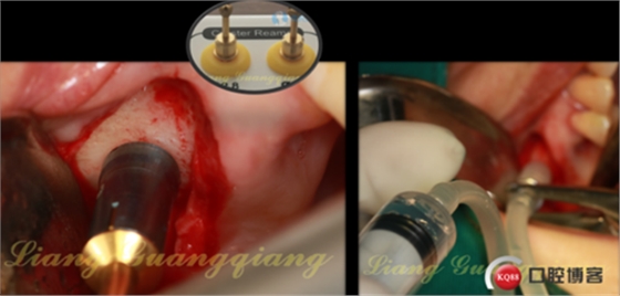 上頜竇外提升術(shù)中對大囊腫的處理 上頜竇外提升術(shù)中對大囊腫的處理