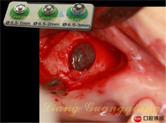 上頜竇外提升術(shù)中對大囊腫的處理 上頜竇外提升術(shù)中對大囊腫的處理
