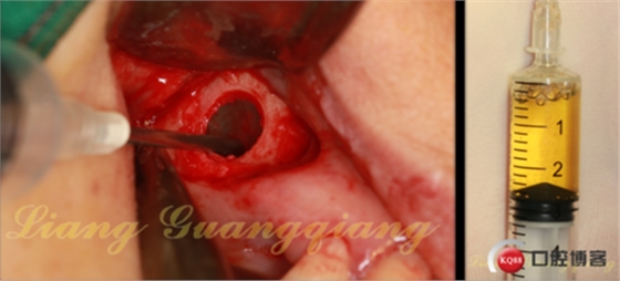 上頜竇外提升術(shù)中對大囊腫的處理 上頜竇外提升術(shù)中對大囊腫的處理