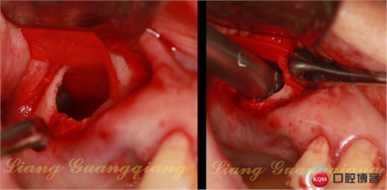 上頜竇外提升術(shù)中對大囊腫的處理 上頜竇外提升術(shù)中對大囊腫的處理