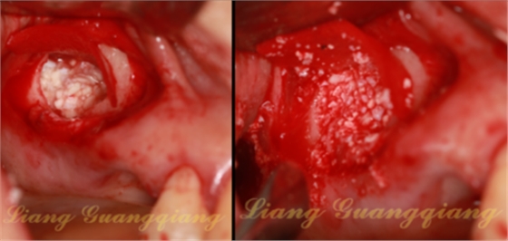 上頜竇外提升術(shù)中對大囊腫的處理 上頜竇外提升術(shù)中對大囊腫的處理