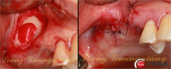 上頜竇外提升術(shù)中對大囊腫的處理 上頜竇外提升術(shù)中對大囊腫的處理