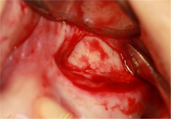 上頜竇外提升術(shù)中對大囊腫的處理 上頜竇外提升術(shù)中對大囊腫的處理