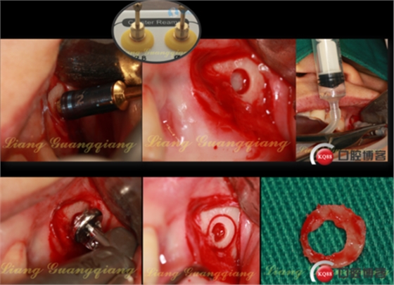 上頜竇外提升術(shù)中對大囊腫的處理 上頜竇外提升術(shù)中對大囊腫的處理