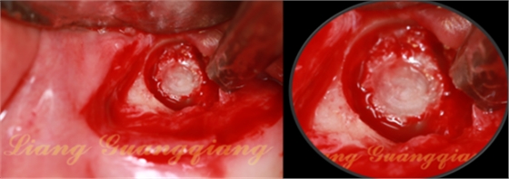 上頜竇外提升術(shù)中對大囊腫的處理 上頜竇外提升術(shù)中對大囊腫的處理