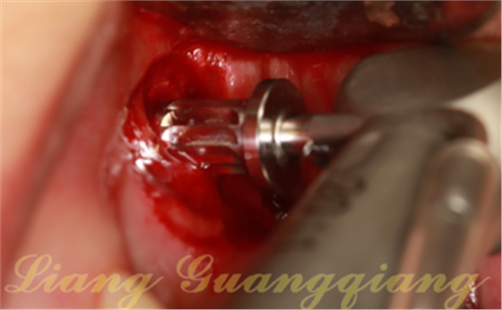 上頜竇外提升術(shù)中對大囊腫的處理 上頜竇外提升術(shù)中對大囊腫的處理