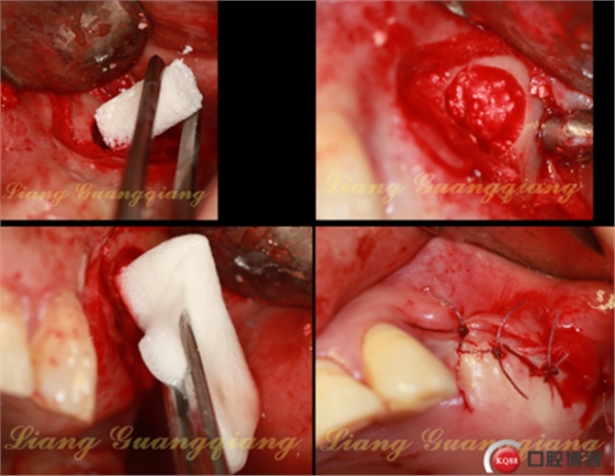 上頜竇外提升術(shù)中對大囊腫的處理 上頜竇外提升術(shù)中對大囊腫的處理