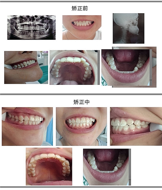 美立刻隱形矯正 美立刻隱形矯正