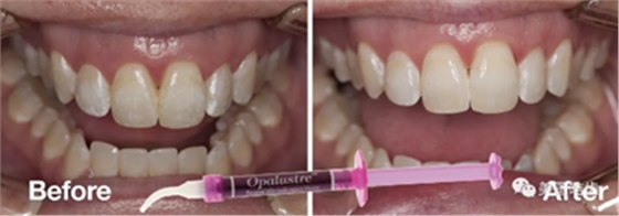 氟斑牙的克星--美國皓齒微創(chuàng)治療法 氟斑牙的克星--美國皓齒微創(chuàng)治療法