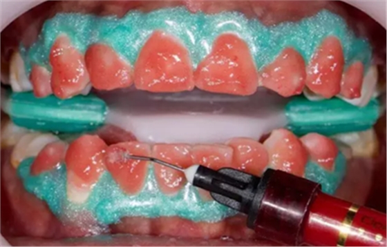 氟斑牙的克星--美國皓齒微創(chuàng)治療法 氟斑牙的克星--美國皓齒微創(chuàng)治療法