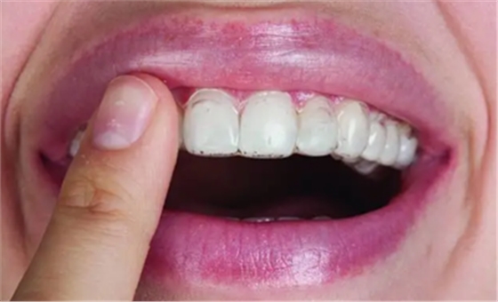 氟斑牙的克星--美國皓齒微創(chuàng)治療法 氟斑牙的克星--美國皓齒微創(chuàng)治療法