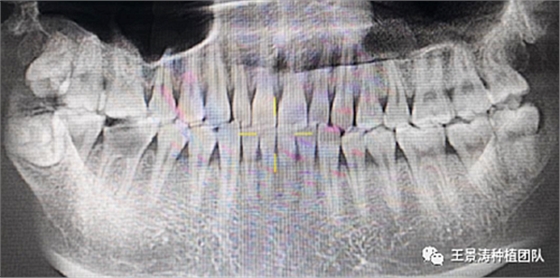 后牙區(qū)即刻種植的適應(yīng)癥的思考 后牙區(qū)即刻種植的適應(yīng)癥的思考