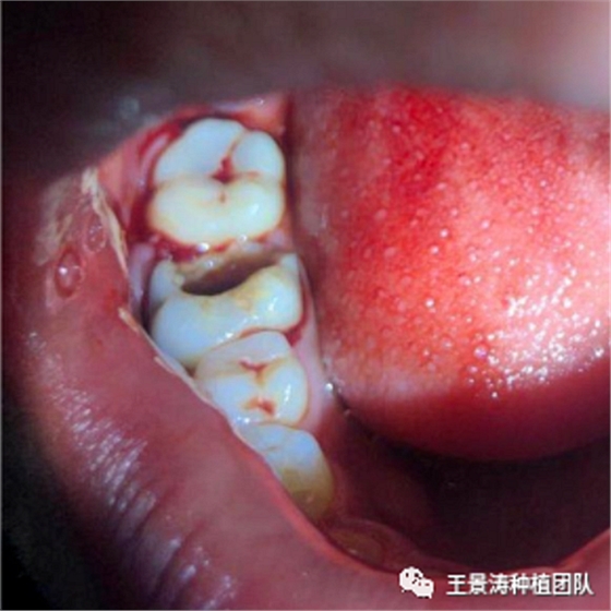 后牙區(qū)即刻種植的適應(yīng)癥的思考 后牙區(qū)即刻種植的適應(yīng)癥的思考