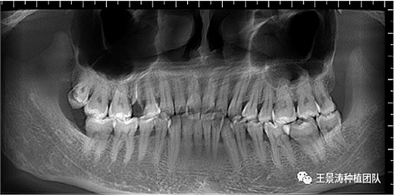后牙區(qū)即刻種植的適應(yīng)癥的思考 后牙區(qū)即刻種植的適應(yīng)癥的思考