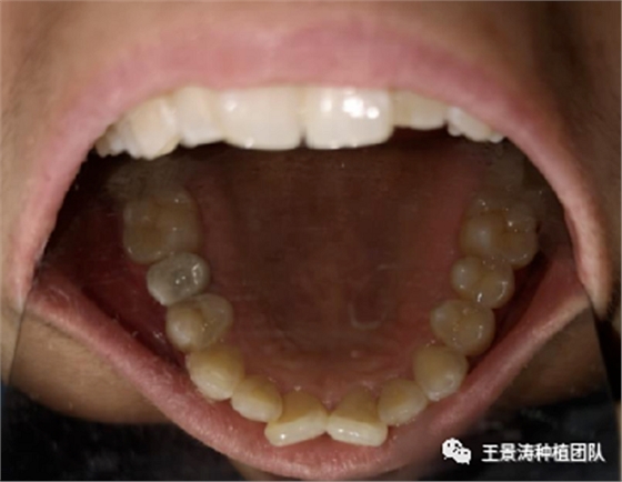 后牙區(qū)即刻種植的適應(yīng)癥的思考 后牙區(qū)即刻種植的適應(yīng)癥的思考