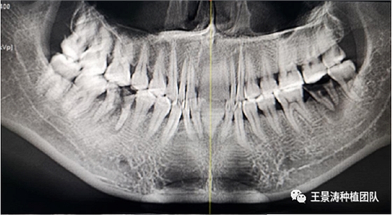 后牙區(qū)即刻種植的適應(yīng)癥的思考 后牙區(qū)即刻種植的適應(yīng)癥的思考