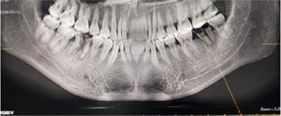 后牙區(qū)即刻種植的適應(yīng)癥的思考 后牙區(qū)即刻種植的適應(yīng)癥的思考