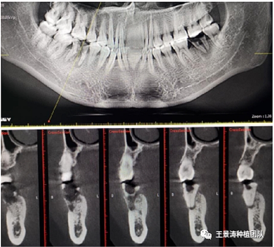 后牙區(qū)即刻種植的適應(yīng)癥的思考 后牙區(qū)即刻種植的適應(yīng)癥的思考