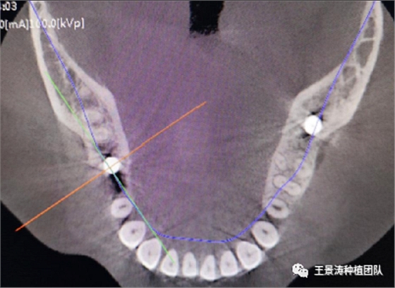 后牙區(qū)即刻種植的適應(yīng)癥的思考 后牙區(qū)即刻種植的適應(yīng)癥的思考