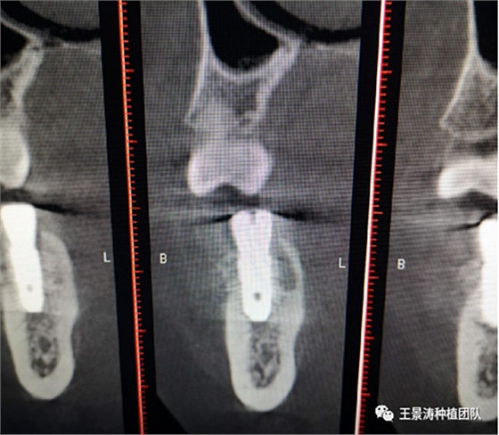 后牙區(qū)即刻種植的適應(yīng)癥的思考 后牙區(qū)即刻種植的適應(yīng)癥的思考