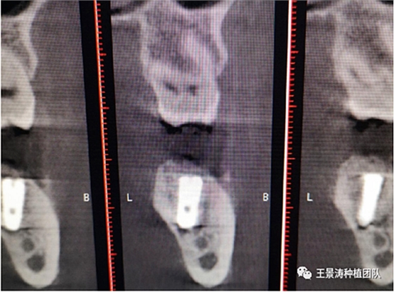 后牙區(qū)即刻種植的適應(yīng)癥的思考 后牙區(qū)即刻種植的適應(yīng)癥的思考