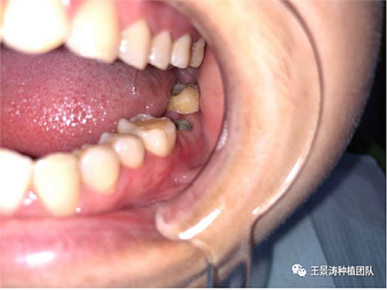 后牙區(qū)即刻種植的適應(yīng)癥的思考 后牙區(qū)即刻種植的適應(yīng)癥的思考