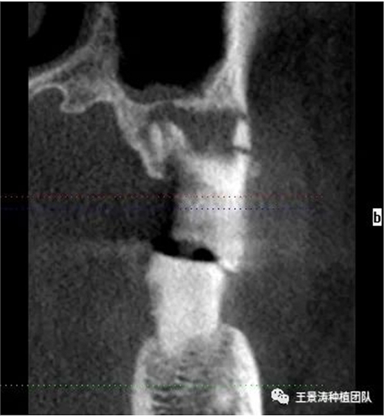 后牙區(qū)即刻種植的適應(yīng)癥的思考 后牙區(qū)即刻種植的適應(yīng)癥的思考