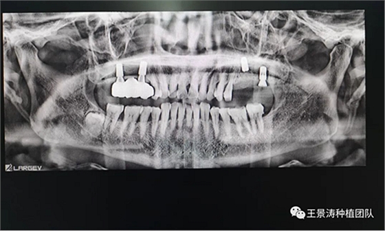 后牙區(qū)即刻種植的適應(yīng)癥的思考 后牙區(qū)即刻種植的適應(yīng)癥的思考