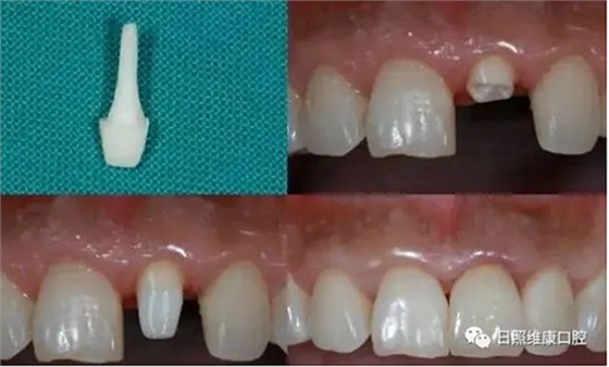 口腔科普 | 殘根殘冠怎么辦——樁核冠 口腔科普 | 殘根殘冠怎么辦——樁核冠
