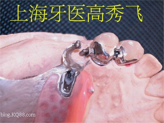 圖解后牙精密附著體修復2例（原創(chuàng)）