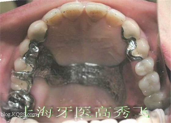 圖解后牙精密附著體修復2例（原創(chuàng)）