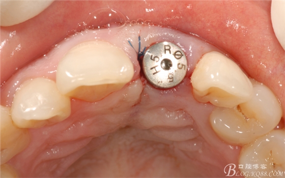 種植美學軟組織塑形(原創(chuàng)不得轉載) 種植美學軟組織塑形(原創(chuàng)不得轉載)
