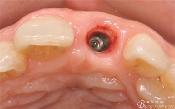 種植美學軟組織塑形(原創(chuàng)不得轉載) 種植美學軟組織塑形(原創(chuàng)不得轉載)