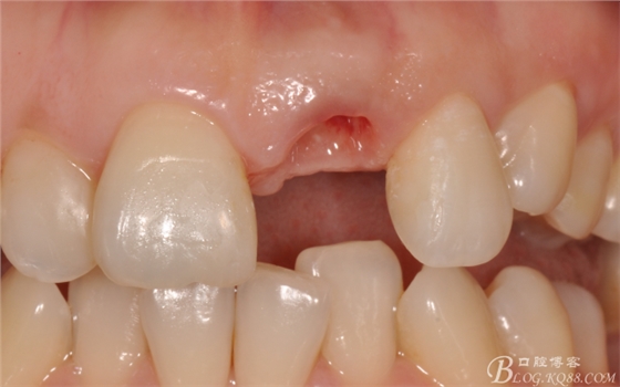 種植美學軟組織塑形(原創(chuàng)不得轉載) 種植美學軟組織塑形(原創(chuàng)不得轉載)