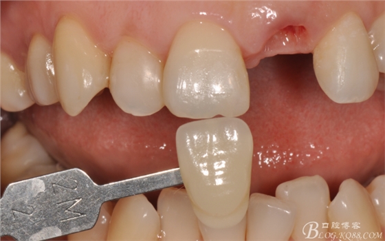 種植美學軟組織塑形(原創(chuàng)不得轉載) 種植美學軟組織塑形(原創(chuàng)不得轉載)