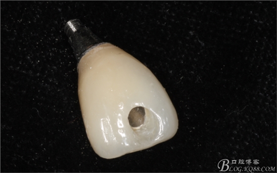 種植美學軟組織塑形(原創(chuàng)不得轉載) 種植美學軟組織塑形(原創(chuàng)不得轉載)