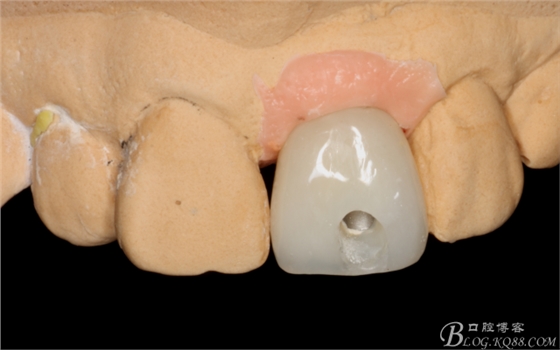 種植美學軟組織塑形(原創(chuàng)不得轉載) 種植美學軟組織塑形(原創(chuàng)不得轉載)