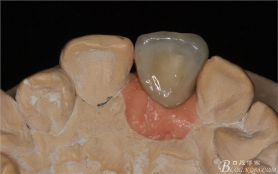 種植美學軟組織塑形(原創(chuàng)不得轉載) 種植美學軟組織塑形(原創(chuàng)不得轉載)