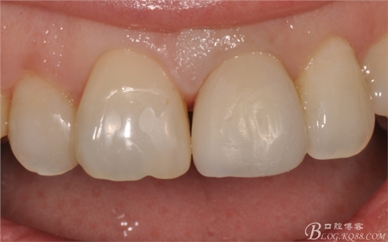 種植美學軟組織塑形(原創(chuàng)不得轉載) 種植美學軟組織塑形(原創(chuàng)不得轉載)