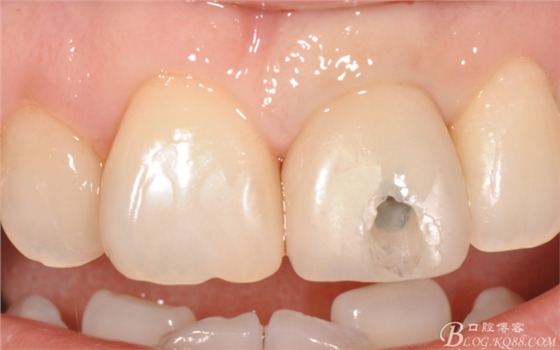 種植美學軟組織塑形(原創(chuàng)不得轉載) 種植美學軟組織塑形(原創(chuàng)不得轉載)