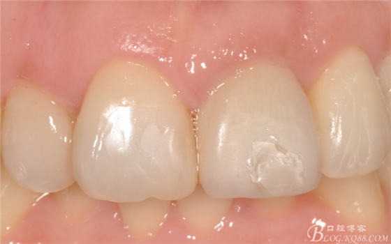 種植美學軟組織塑形(原創(chuàng)不得轉載) 種植美學軟組織塑形(原創(chuàng)不得轉載)