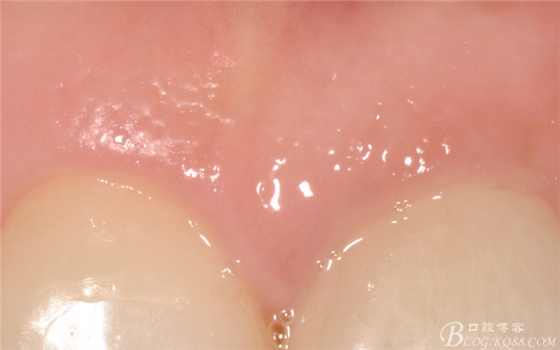 種植美學軟組織塑形(原創(chuàng)不得轉載) 種植美學軟組織塑形(原創(chuàng)不得轉載)